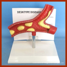 Desk Type (Bluthochdruck schädliche Effekte) Disease Artery Model mit Descritption Plate